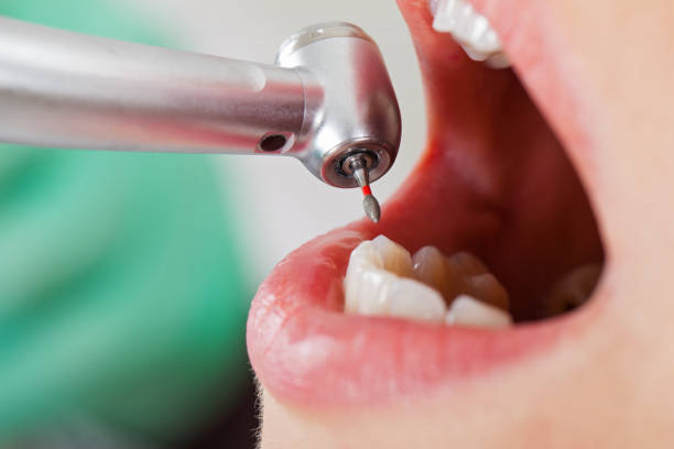Teeth Whitening in IL
